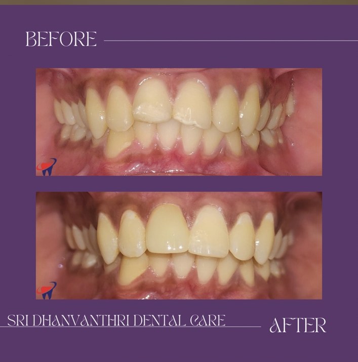 Before-and-after smile restoration example shared by the clinic